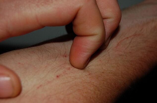 coceira na pel como síntoma da presenza de parasitos