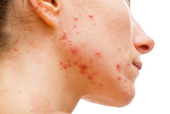 Acne debido a parasitos subcutáneos