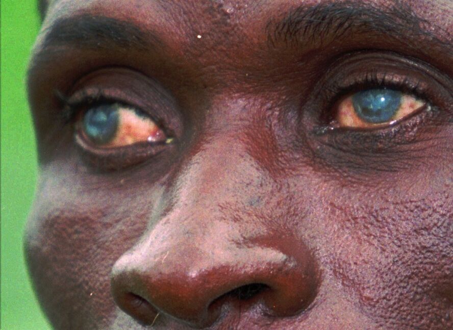 Parasitos no ollo humano