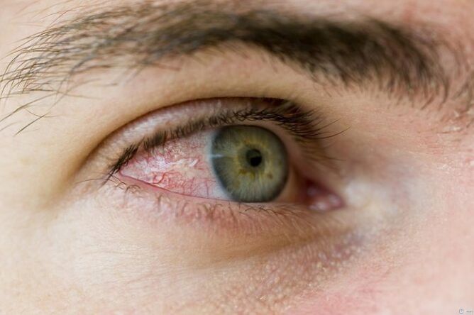 Problemas oculares debido a parasitos