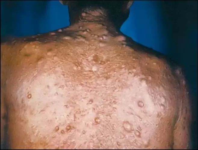 nódulos purulentos na pel debido a parasitos